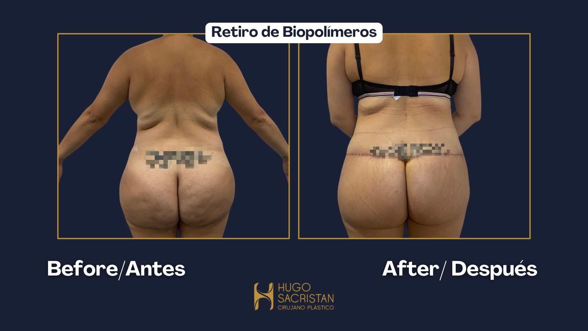 Caso de retiro de biopolímeros — antes y después (1)
