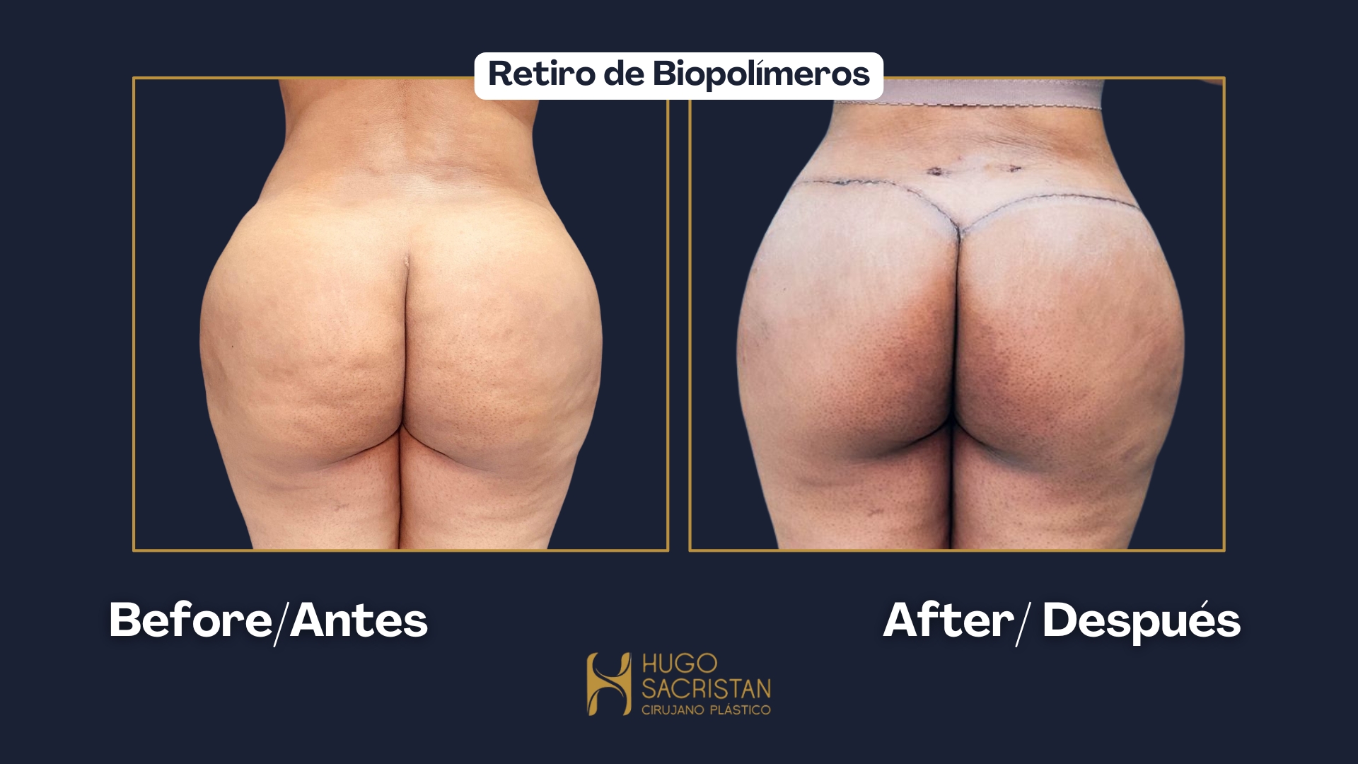 Caso de retiro de biopolímeros — antes y después (2)