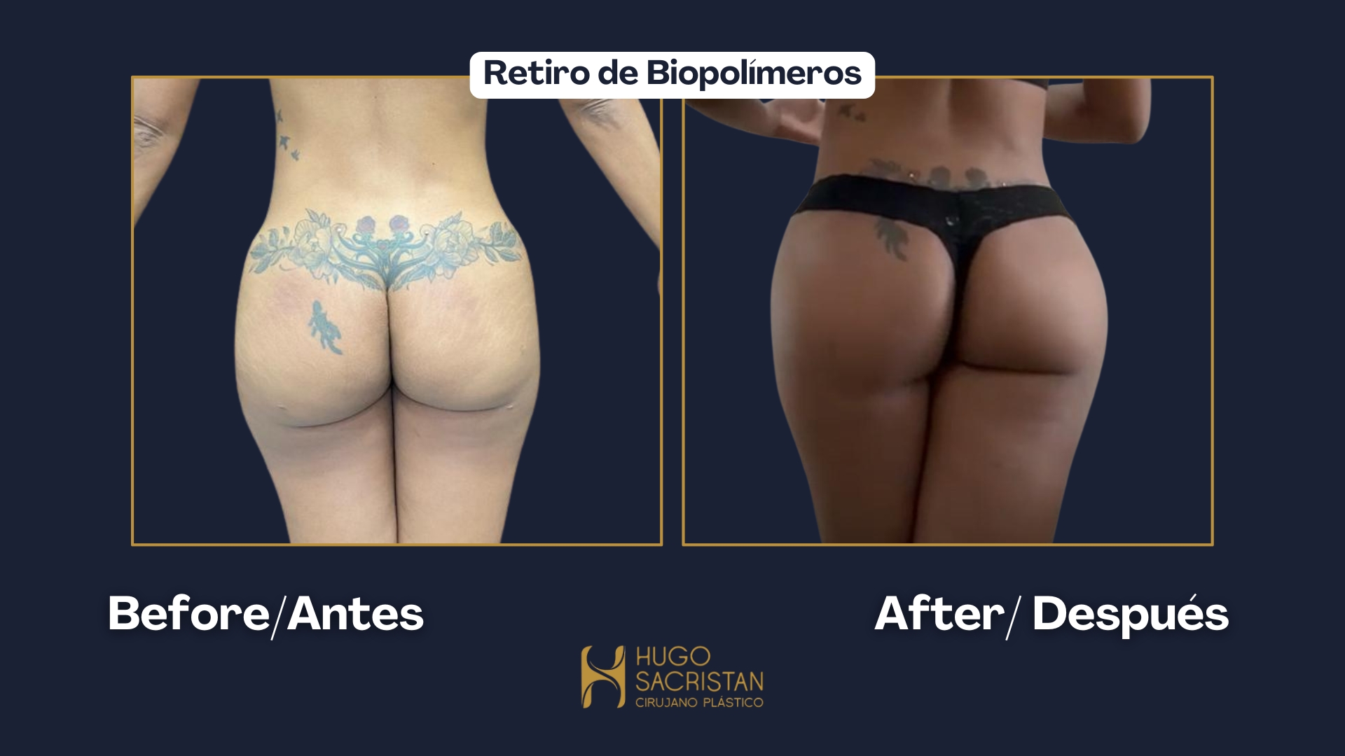 Caso de retiro de biopolímeros — antes y después (3)